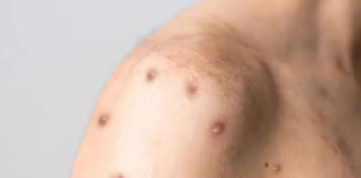 Nova cepa do vírus da Mpox recombinante preocupa OMS e testes mostram que antiviral mais usado não é eficaz