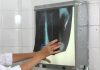 Taubaté intensifica busca ativa de casos de tuberculose