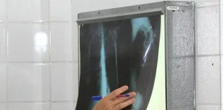 Taubaté intensifica busca ativa de casos de tuberculose